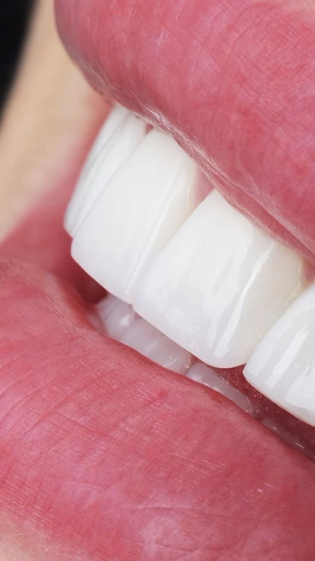 Formación blanqueamiento dental SIN KIT PROFESIONAL